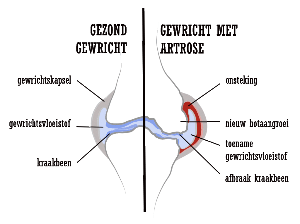 gewricht met artrose